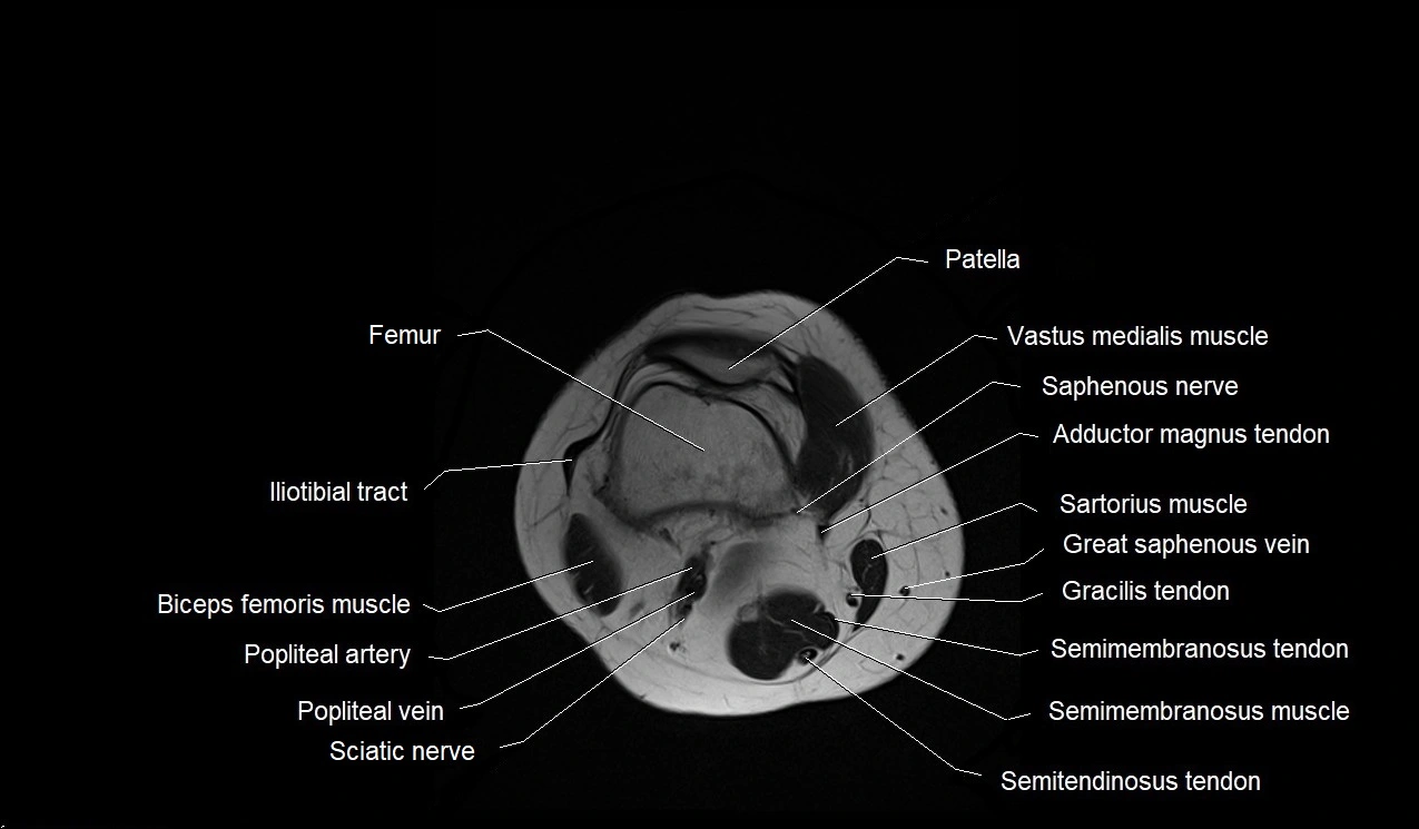 MRI thigh cross sectional anatomy image 53.webp